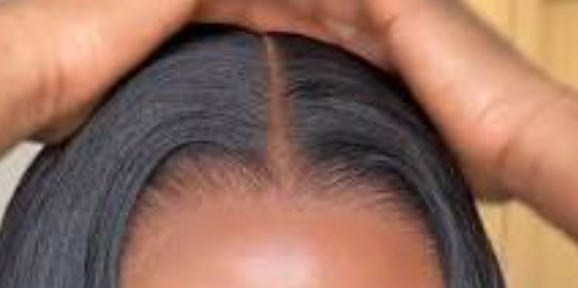 Natural Hairline